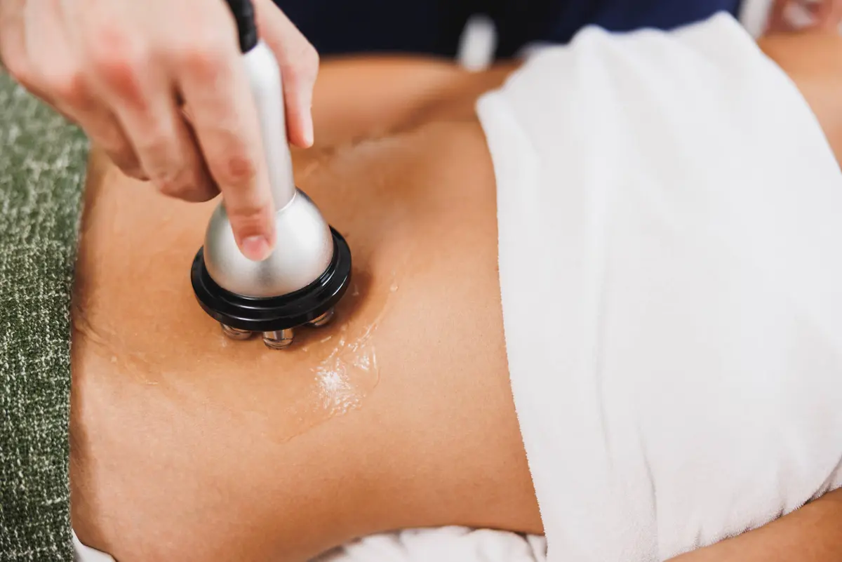 An RF lifting treatment